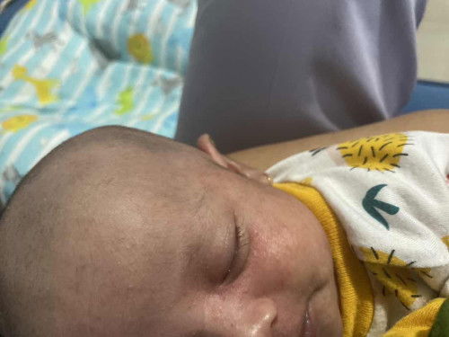 biang keringat di muka baby