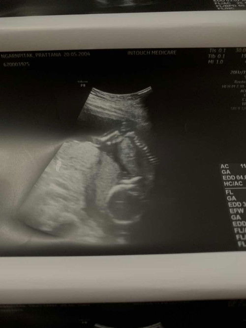 อยากทราบเพศลูก แต่..