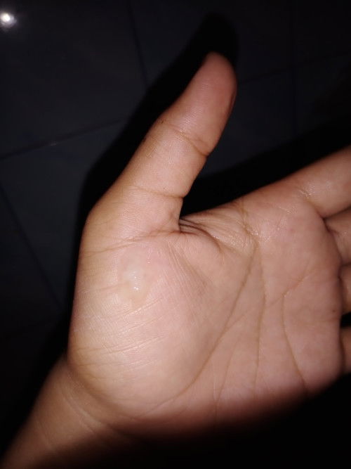 ตกขาวเป็นก้อน