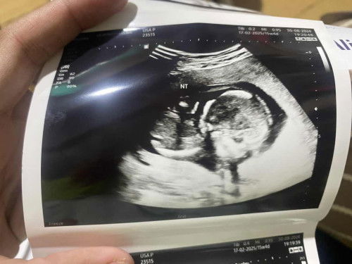 ฝากครรภ์รพ. ไม่ค่อยตรวจอะไรให้เลย ซาวครั้ง1 ดูอายุครรภ์ 27/8/67 เจาะเลือดดูดาวน์รอผลวันที่06/09/67