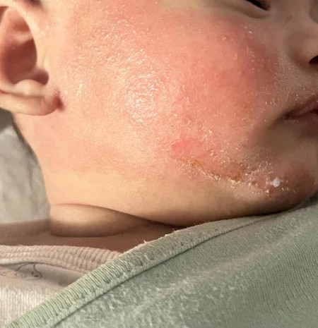 Eczema? What to do