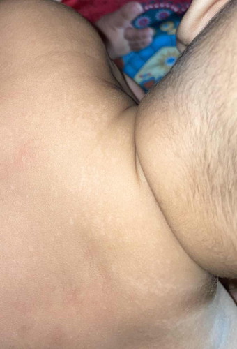 Tompok putih pada belakang bayi