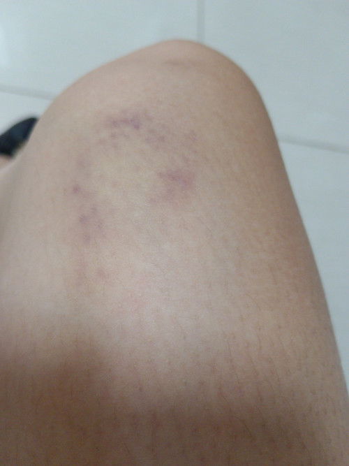 Bakit nagkakaroon ng parang ube sa may part ng hita or sa ibang part? Di naman ako nababangga.