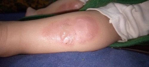 Cara mengatasi bekas luka bakar