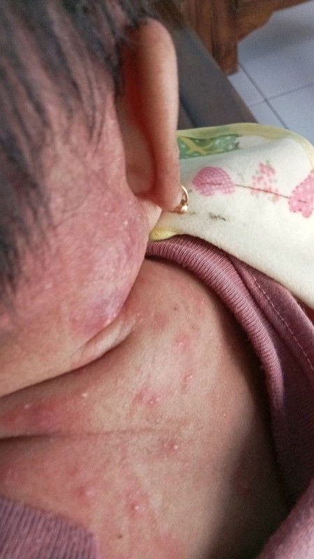 Bun,mau nanya 
Ada gak yg anaknya pernah gatal kaya gini??