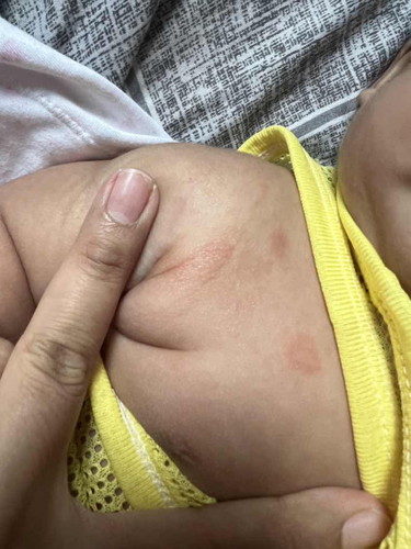 ลูก3เดือนมีผื่นขึ้นเป็นขุยๆ