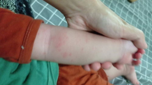 Kulit bintik² merah hilang timbul