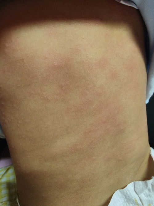 ผื่นที่ลำตัว