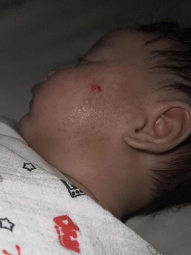 Macam mana nak elak baby daripada garu eczema