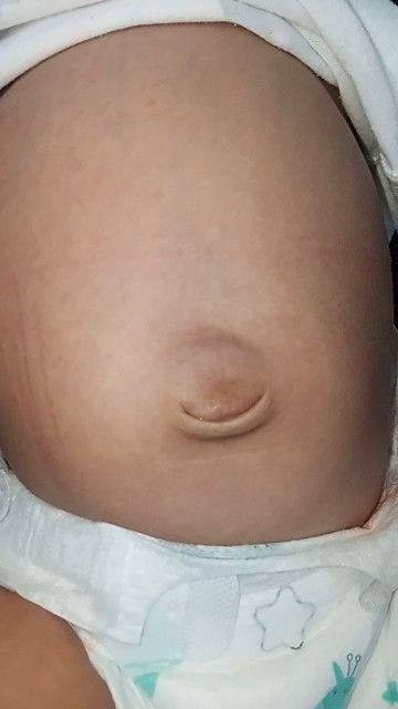Umbilical hernia