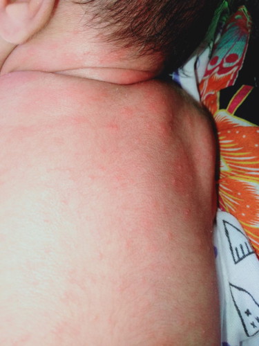Ada yang tau ga bun ini kenapa ya baby newborn 11 hri badannya merah² sma bintik² kcil bgtu kenpa ya