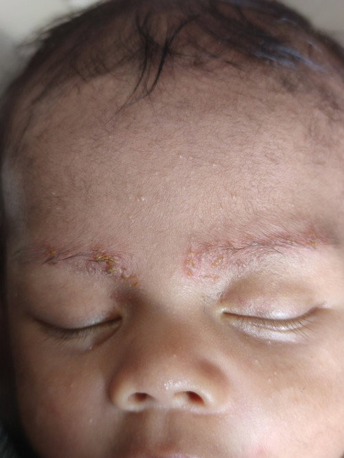 Alis bayi merah dan ada bintik kuning