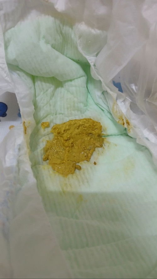 อุจจาระลูกแบบนี้ปกติไหมค่ะ ทานนมผงเอนฟาเปลี่ยนจากไฮคิวค่ะ