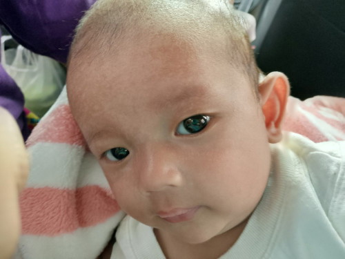 เกลื้อนน้ำนม