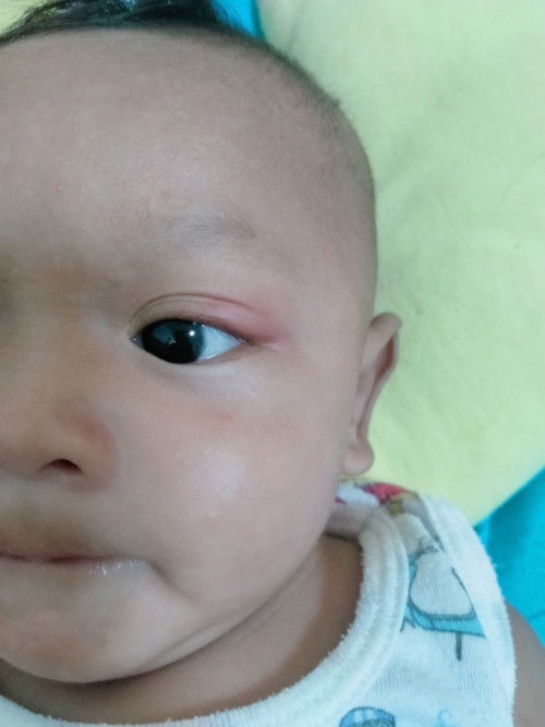 น้องตาบวมแดงที่บริเวณหางตา