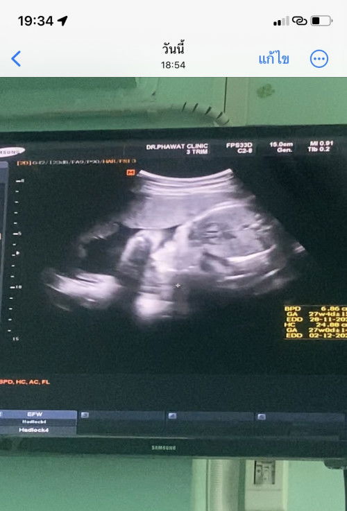 หัวมุดช่องคลอด