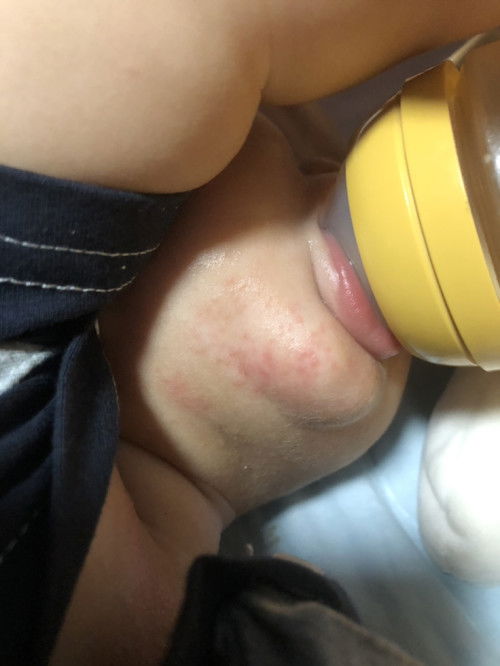 น้องเปนผื่นแดงแบบนี้ ใช้ครีมอะไรดีคะแม่ๆช่วยแนะนำน่อยค่ะ ส่วนตัวใช้เฟแอนเม และ ยูเซอรีนแล่วไม่หาย