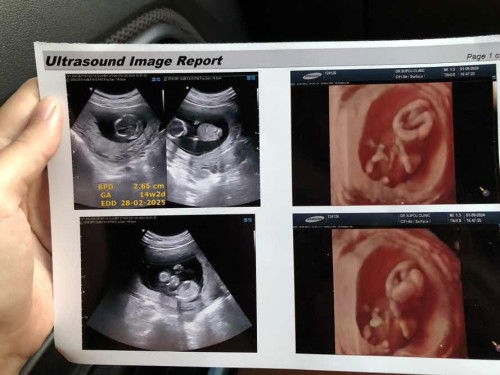 ตั้งครรภ์#ท้องแรก#