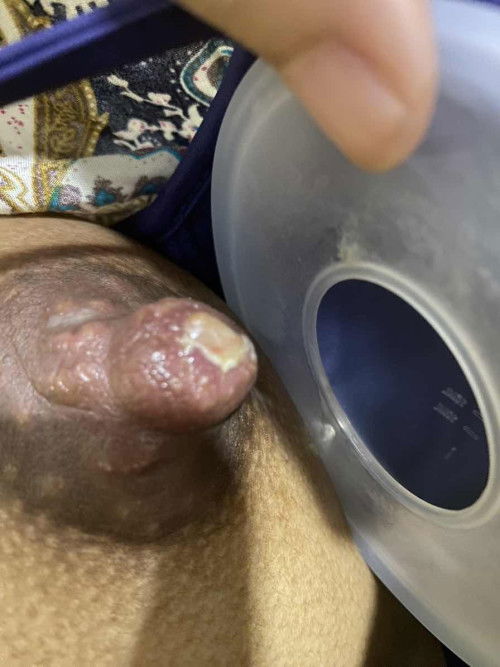 Painful Breast need help