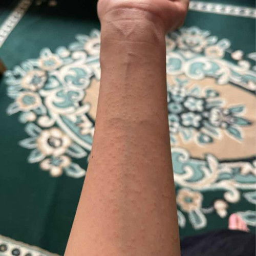 Muncul bintik2 kecil gatal