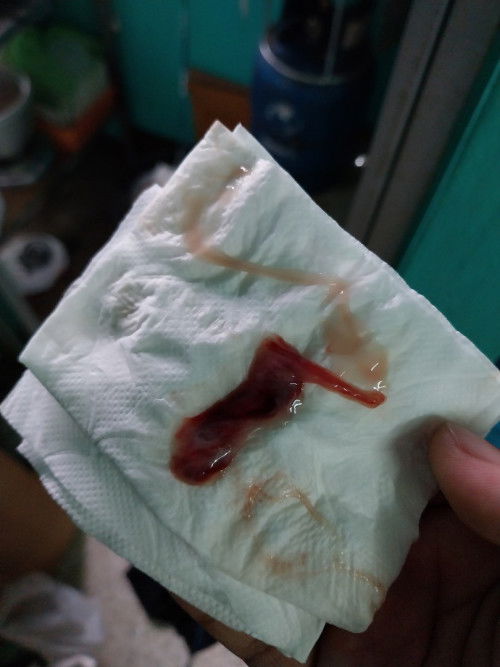 การกระตุ้นคลอดโดยกวาดปากมดลูก