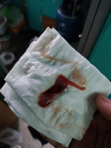 การกระตุ้นคลอดโดยกวาดปากมดลูก