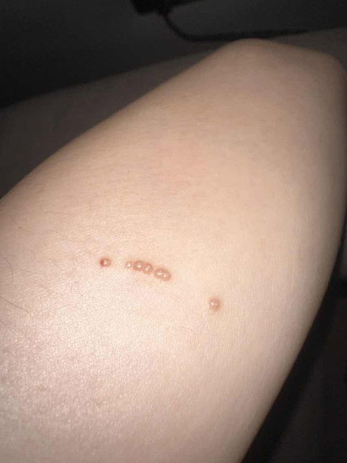 คุณแม่ท่านไหนเคยเป็นบ้างคะ