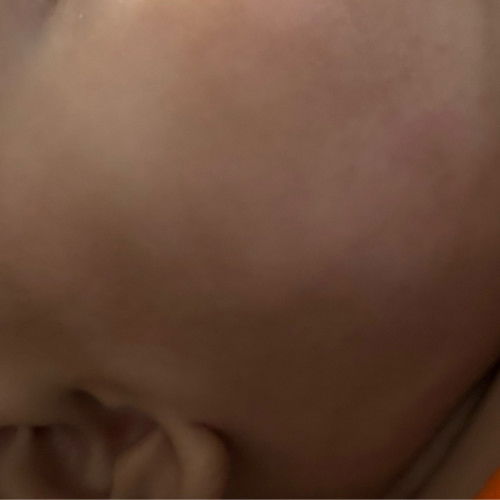 Hi mommy semua,ada tips x nak hilangkn tompok2 putih kat pipi baby saya ni? Dah sebulan mcm ni