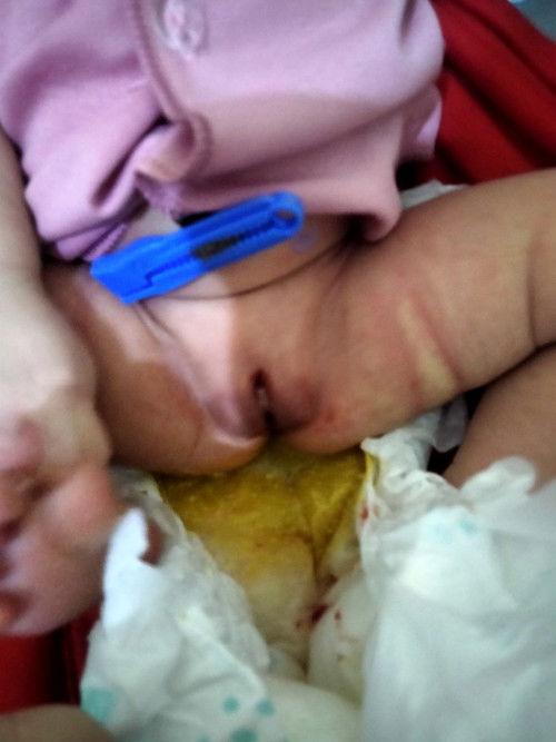 Pup cair dan keluar Darah di Miss V new born 5 hari