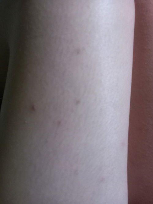 Ada yg pernah merasakan gatal semacam alergi atau lainnya ?