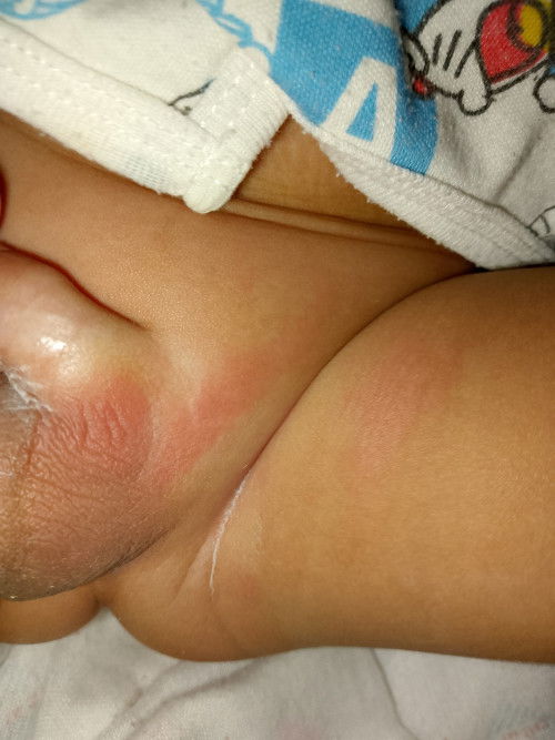 ตรงขาหนีบแดง