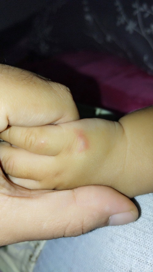 Bayi Hisap jari sampai memar
