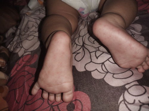 Kaki berbintik merah