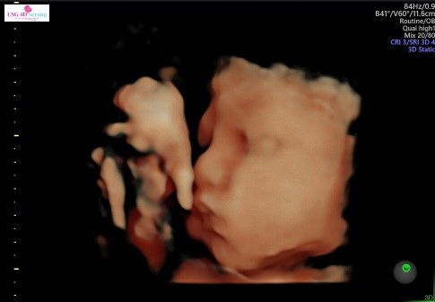 Hallo bunda2 umur ku udah 32minggu BB ku skarng udah 1.8 kg pipiku tambah gemoy loh bun😍