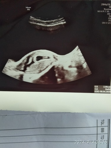 Periksa di obgyn yang berbeda .. Alhamdulillah, sudah ada dde nya 🥹
