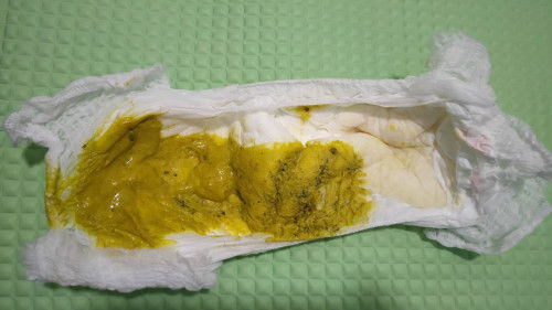 Black particles or strings sa poop ni baby