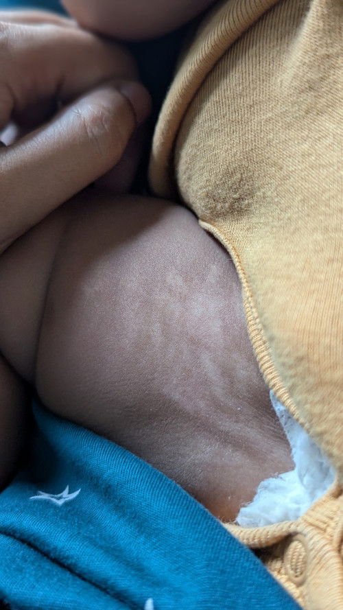 White patches on baby skin, 3 month old.