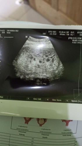 Mau tanya bun, kira² ini bnr hamil anggur apa ga ya, tp aku ga ada flek, apa mending USG tmpt lain?