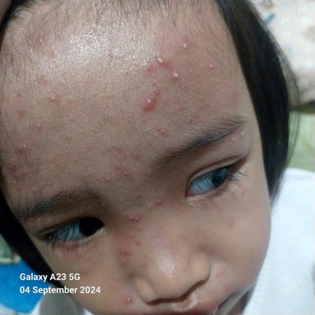 Bun ini kenapa ya udh 1 minggu lebih. Kira² obat nya apa ya.? Trimakasih
