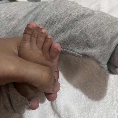 Kelingking kaki bayi agak aneh