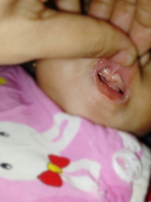 LIP TIE 6 months baby