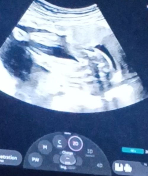 Gender. Girl or boy?