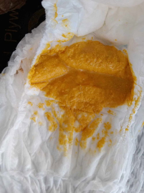 สอบถามแม่ๆค่ะ เคยมีประสบการณ์ลูกถ่ายแบบในภาพมั้ยคะ น้องชอบถ่ายเหลว มีกากนิดหน่อยมีฟองอากาศบางครั้ง