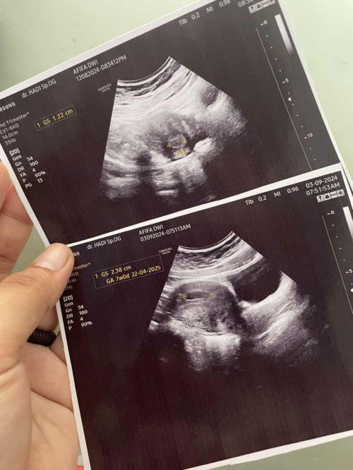 Usia 7w tapi janin belum terlihat