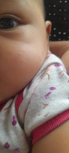 Spots sa face ni baby