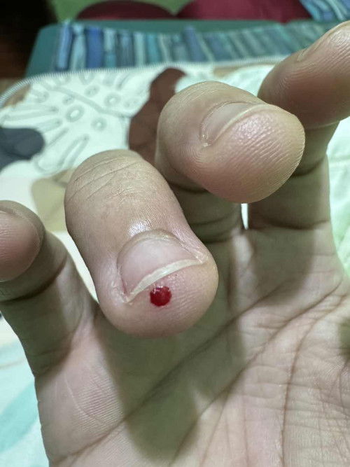 Nakagat po ako ng bubwet (small house rat) sa daliri while sleeping.