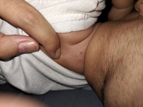 Bintik merah pada kulit bayi usia 4 bulan