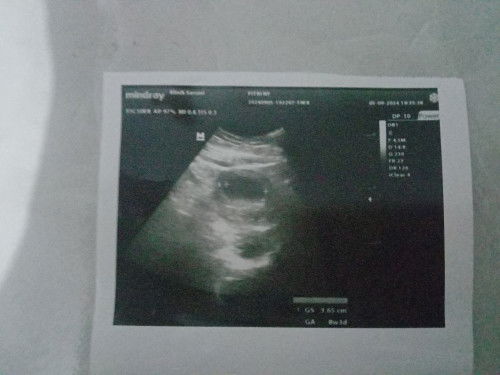 Hamil 8w,janin belum terlihat