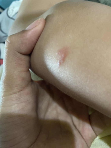 ผื่นแดงนูนแข็ว
