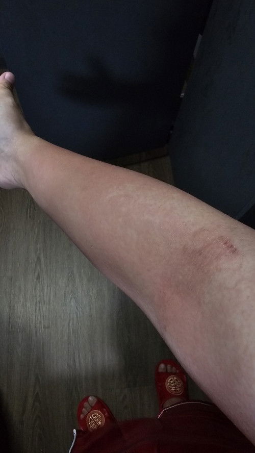 Rashes/hives after giving birth?